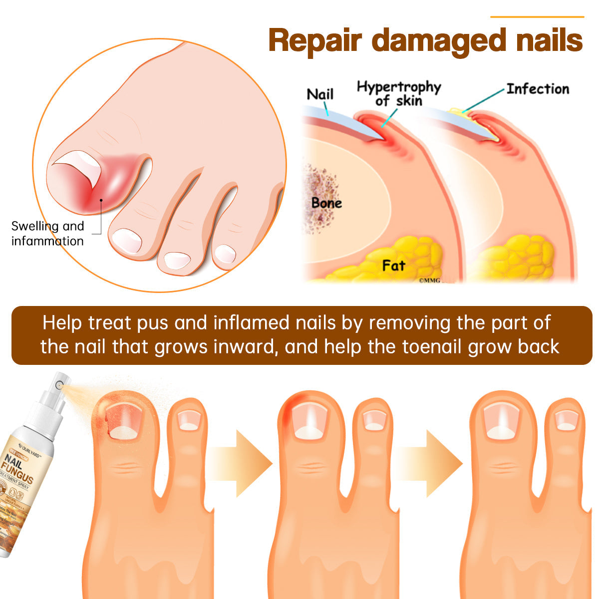 🐝🐝Ourlyard™ Bee Venom Nail Fungus Treatment Spray