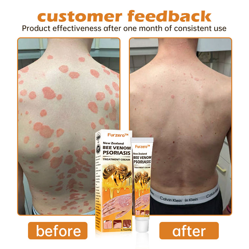 Furzero™ New Zealand Bee Venom Psoriasis Treatment Cream(Suitable for all skin conditions)