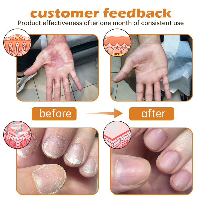 Furzero™ New Zealand Bee Venom Psoriasis Treatment Cream(Suitable for all skin conditions)