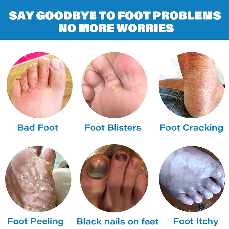 Furzero™ Advanced Medical Grade Herbal Nail Fungus Foot Spray