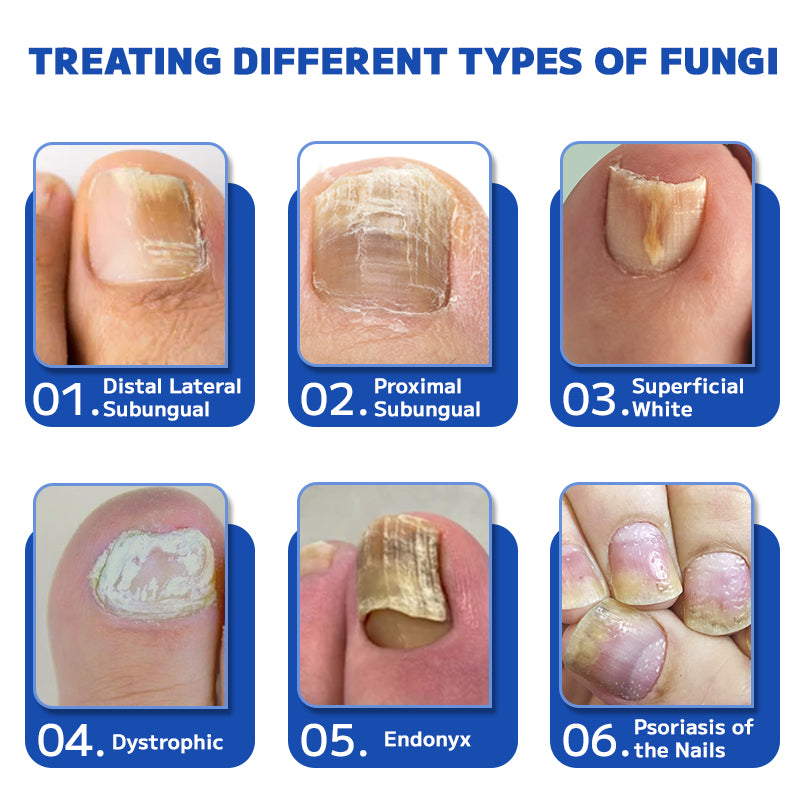 Furzero™ Fungal Nail Treatment Laser Device