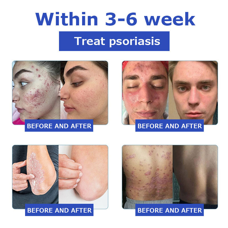 đFurzero⢠OceanCure Bee Venom Psoriasis & Wart Healing Cream