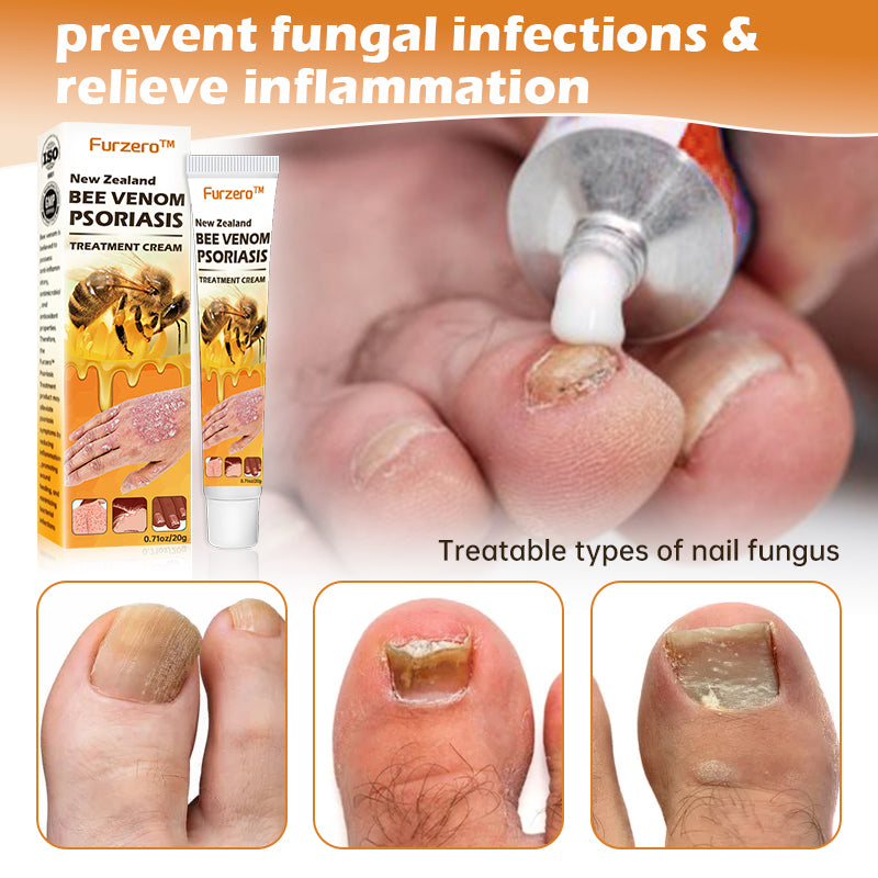 Furzero™ New Zealand Bee Venom Psoriasis Treatment Cream(Suitable for all skin conditions)