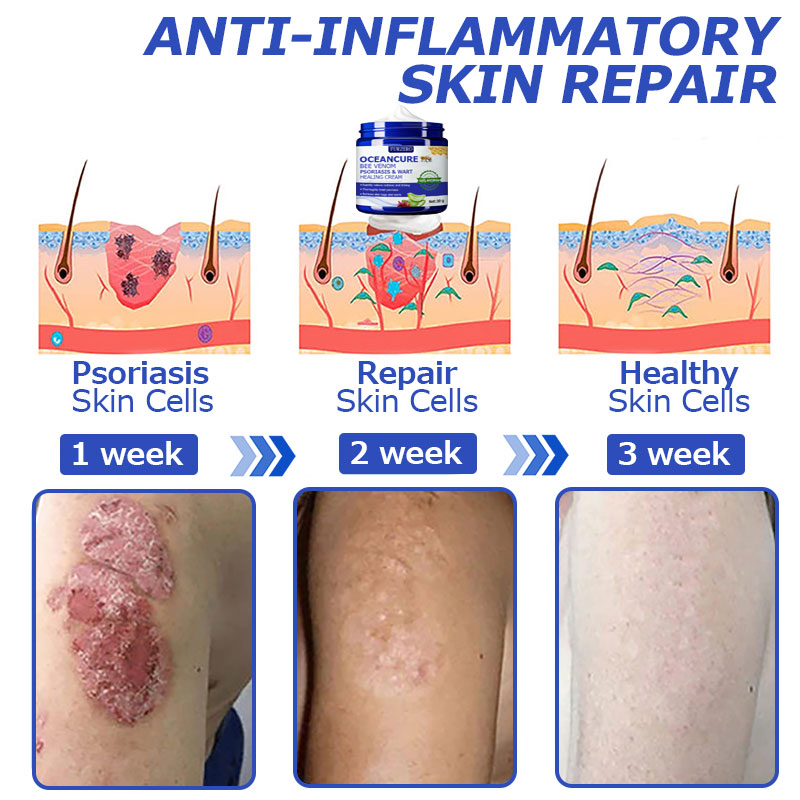 đFurzero⢠OceanCure Bee Venom Psoriasis & Wart Healing Cream