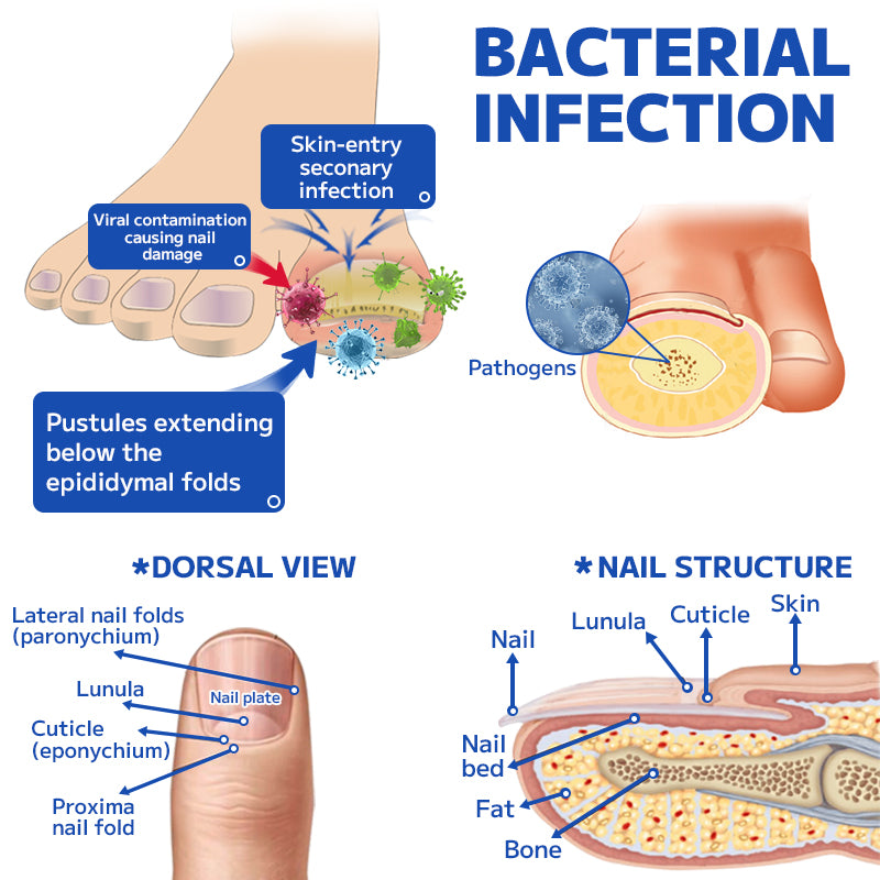 Furzero™ Fungal Nail Treatment Laser Device
