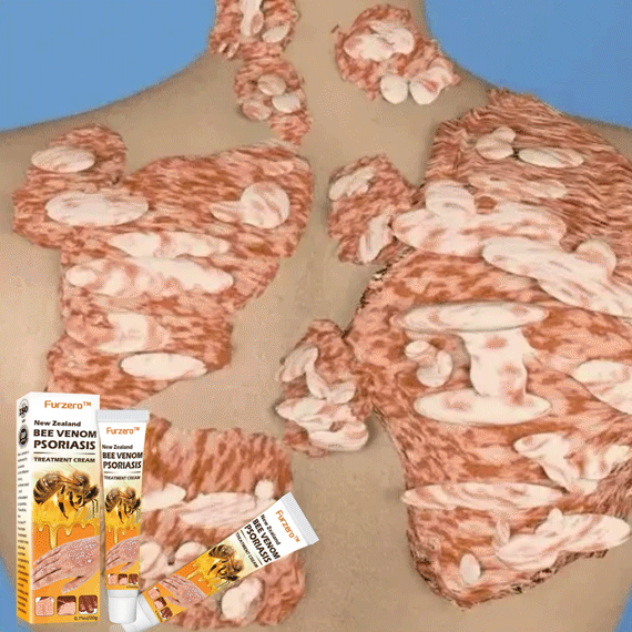 Furzero™ New Zealand Bee Venom Psoriasis Treatment Cream(Suitable for all skin conditions)