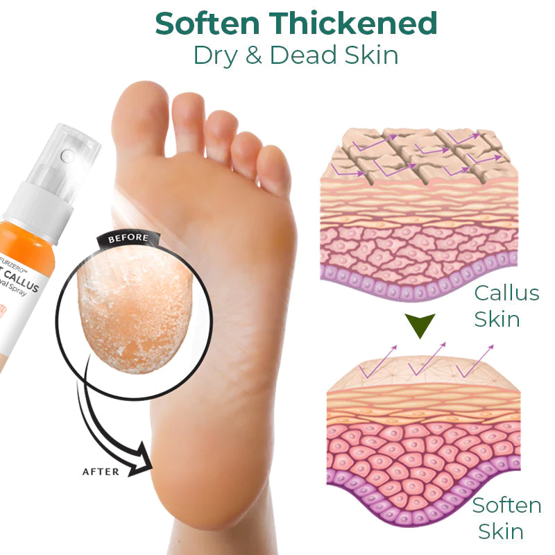 Furzero™ Foot Callus Removal Spray