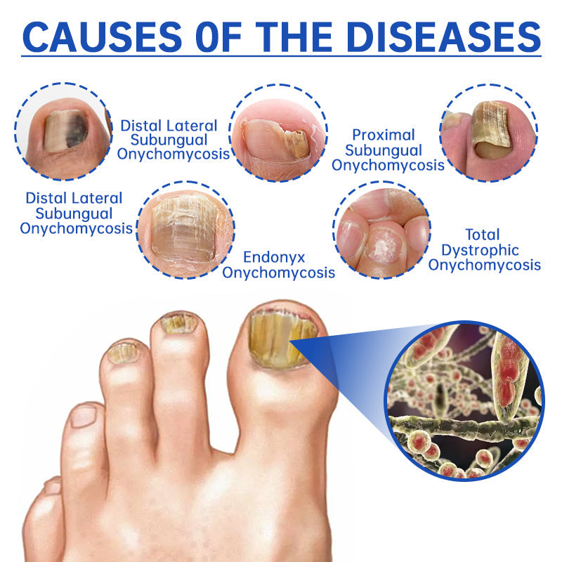š„Furzero⢠PureNail Fungus Laser Therapy Device Hot Sale