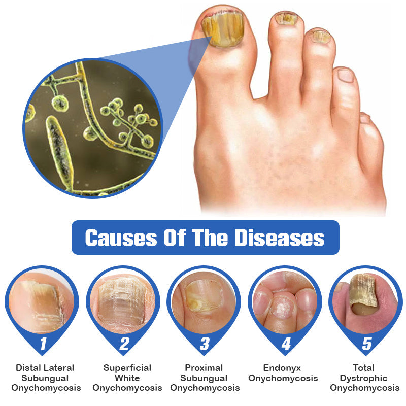 👏Furzero™ Nail Fungus Laser Therapy Device Hot Sale