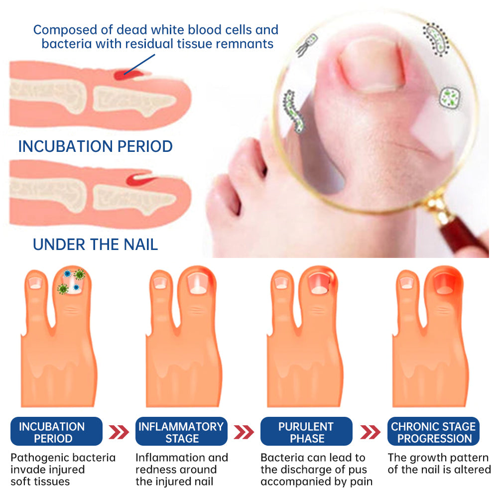 Furzero™ Herbal Formula Fungal nail Paronychia treatment Gel Pro