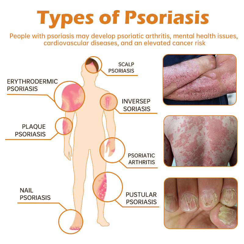 Furzero™ New Zealand Bee Venom Psoriasis Treatment Cream(Suitable for all skin conditions)