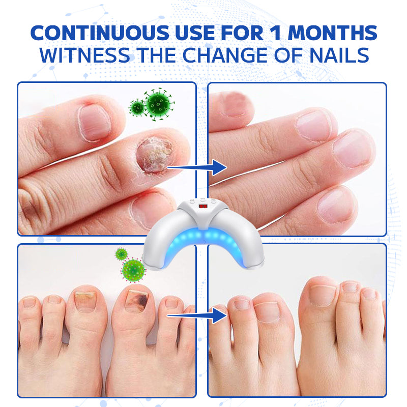 Furzero™ Fungal Nail Treatment Laser Device