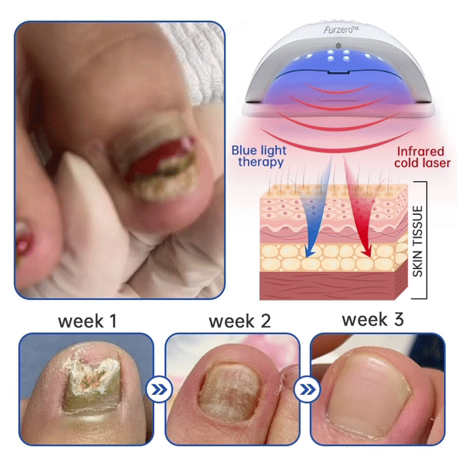 Furzero™ PureNail Fungus Laser Therapy Device Pro
