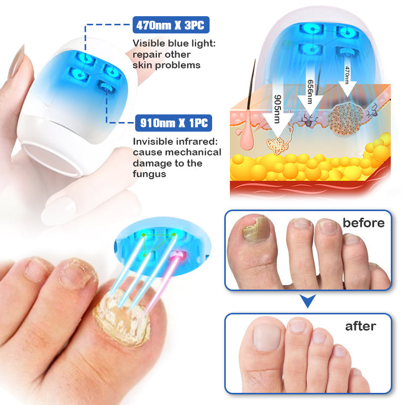Furzero™ Nail Fungus Cleaning Laser Device