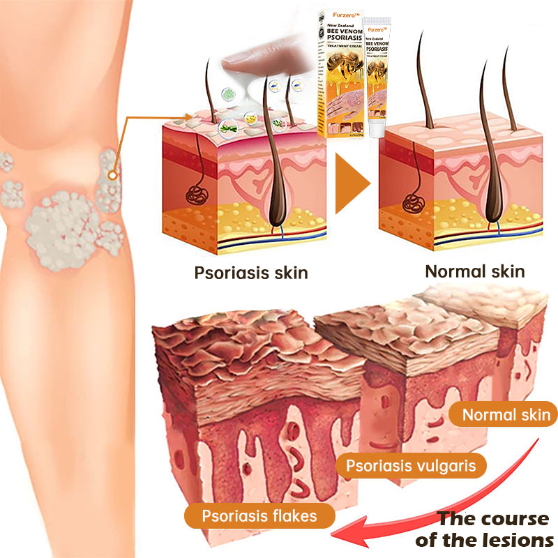 Furzero™ New Zealand Bee Venom Psoriasis Treatment Cream(Suitable for all skin conditions)