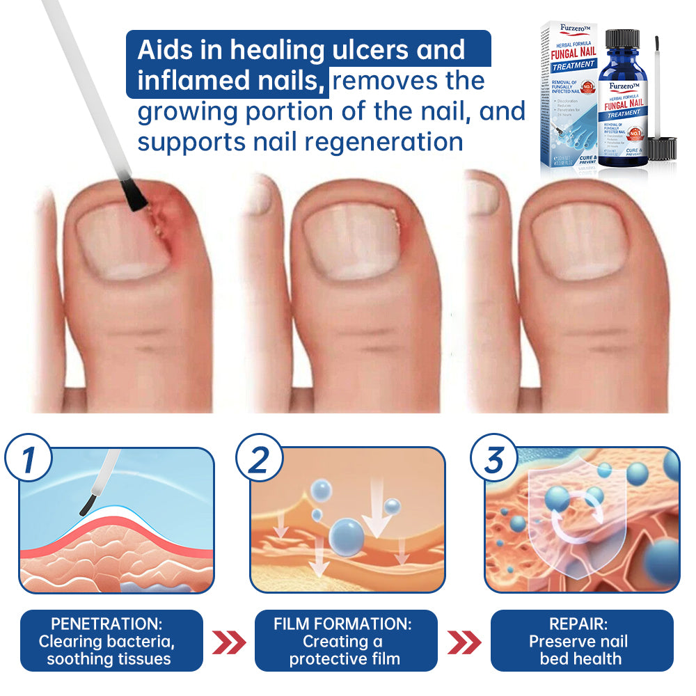 Furzero™ Herbal Formula Fungal nail Paronychia treatment Gel Pro