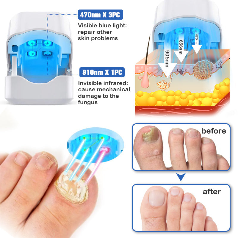 👏Furzero™ Nail Fungus Laser Therapy Device Hot Sale