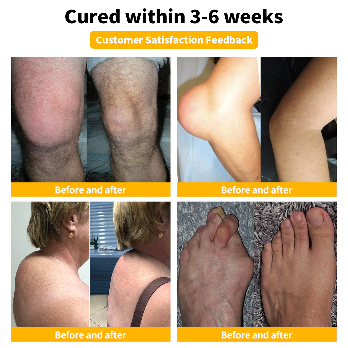 🧑⚕️Furzero™ Bee Venom Arthritis treatment cream(✨ Specially for orthopedic conditions and joint pain ✨)