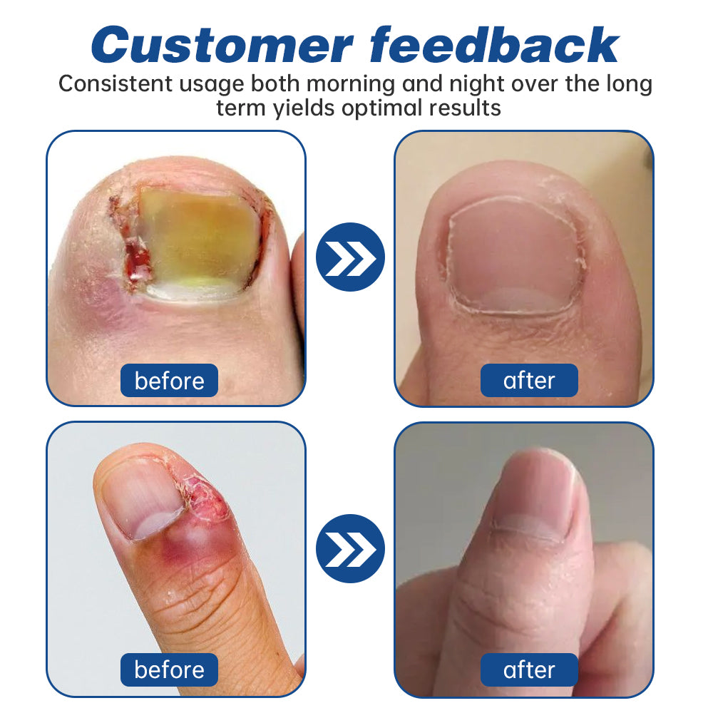 Furzero™ Herbal Formula Fungal nail Paronychia treatment Gel Pro