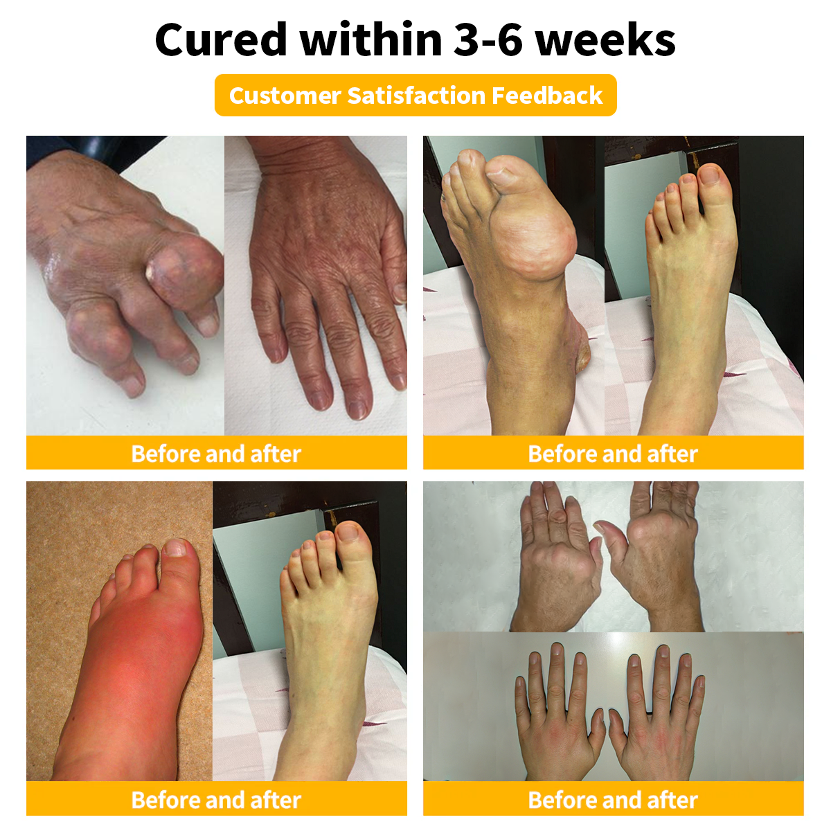 🧑⚕️Furzero™ Bee Venom Arthritis treatment cream(✨ Specially for orthopedic conditions and joint pain ✨)