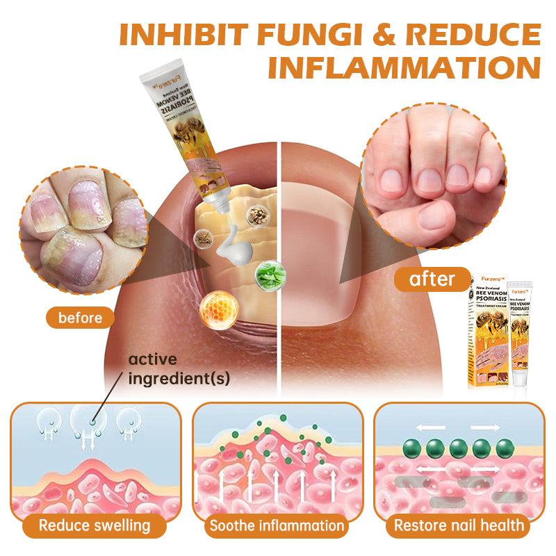 Furzero™ New Zealand Bee Venom Psoriasis Treatment Cream(Suitable for all skin conditions)