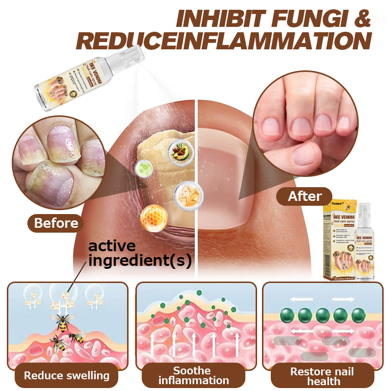 🐝Furzero™ Bee Venom Nail Psoriasis Treatment Spray
