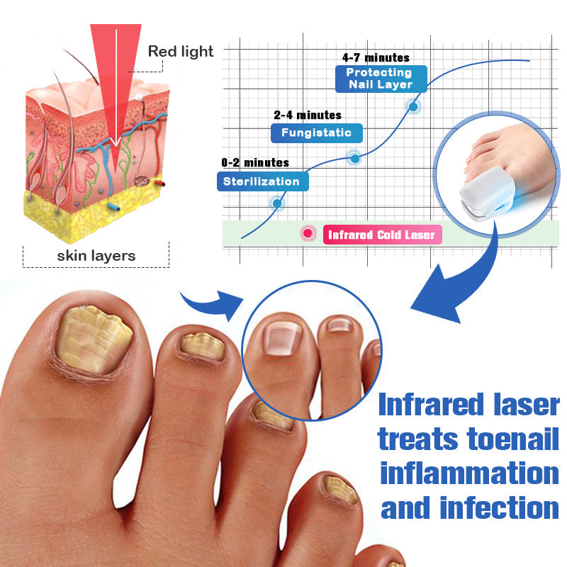 👏Furzero™ Nail Fungus Laser Therapy Device Hot Sale