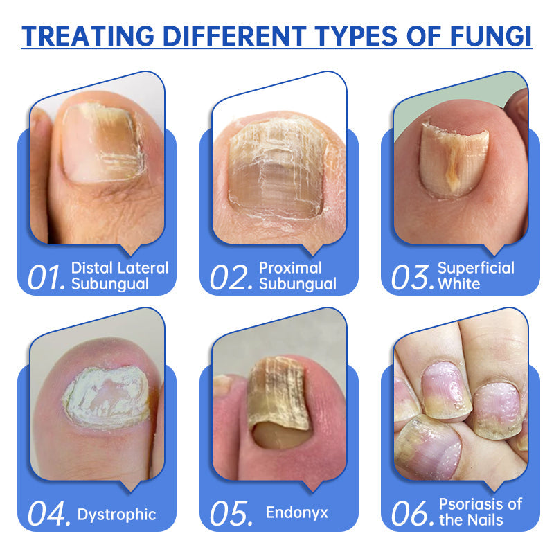 Furzero™ PureNail Fungus Laser Therapy Device Pro