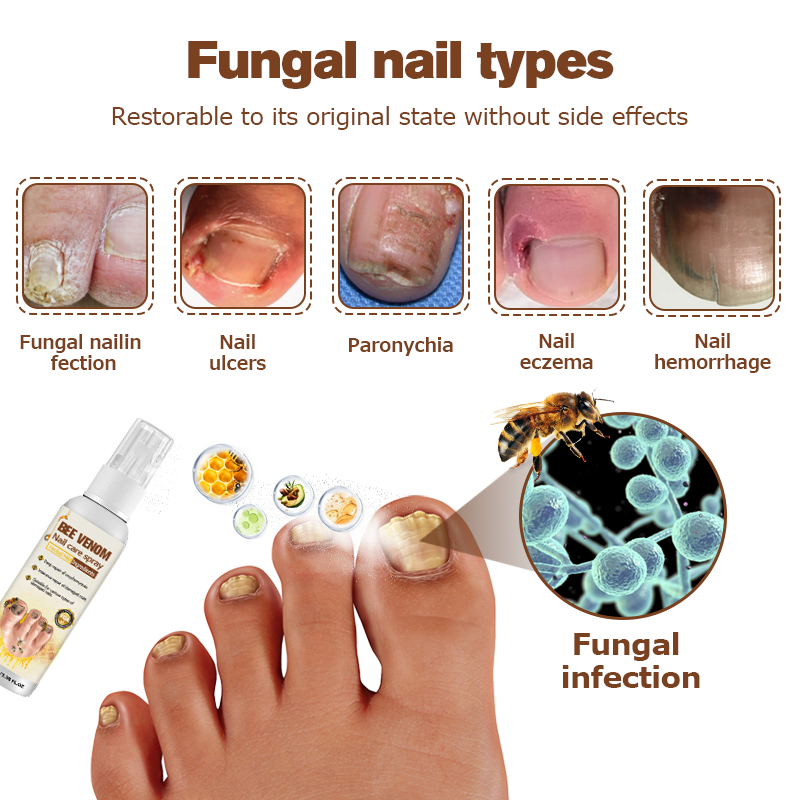 🐝Furzero™ Bee Venom Nail Psoriasis Treatment Spray
