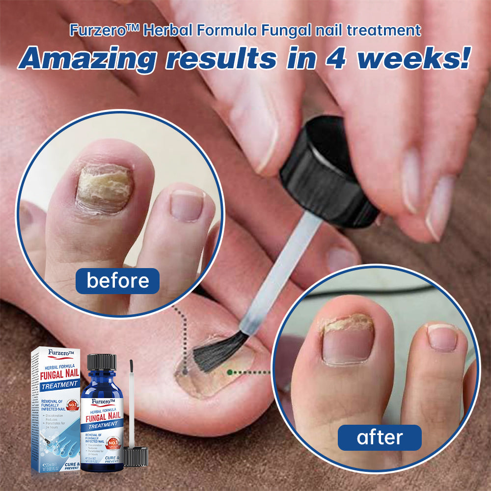 Furzero™ Herbal Formula Fungal nail Paronychia treatment Gel Pro