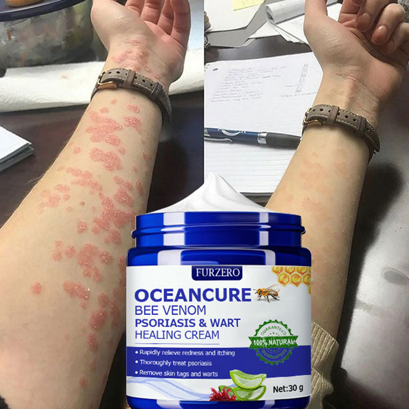 đFurzero⢠OceanCure Bee Venom Psoriasis & Wart Healing Cream