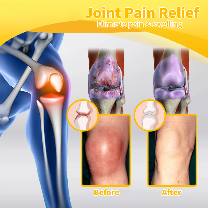 🧑⚕️Furzero™ Bee Venom Arthritis treatment cream(✨ Specially for orthopedic conditions and joint pain ✨)