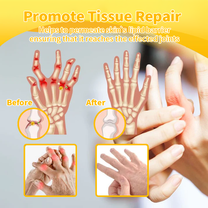 🧑⚕️Furzero™ Bee Venom Arthritis treatment cream(✨ Specially for orthopedic conditions and joint pain ✨)