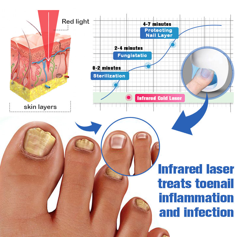 Furzero™ Nail Fungus Cleaning Laser Device
