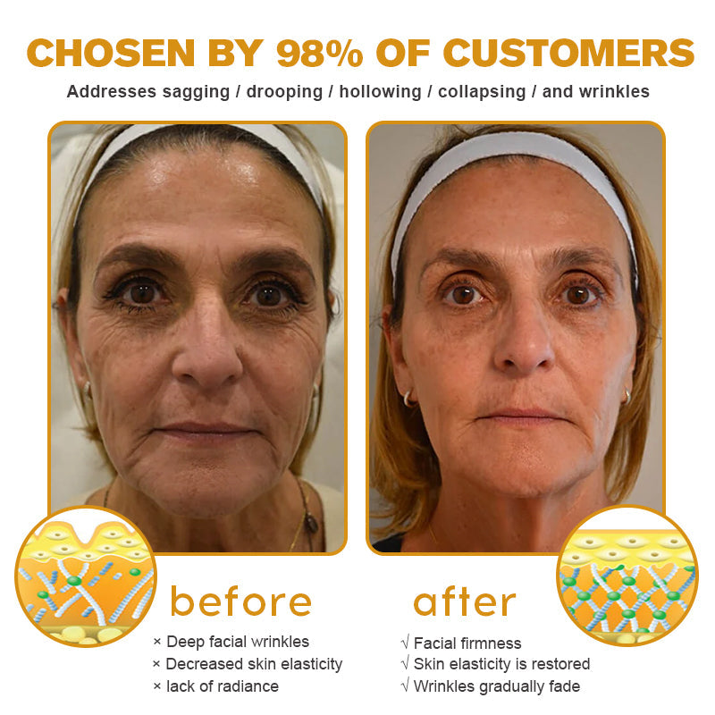 Last Day Promotion 70% OFF - ✨Furzero™ Botox Bee Venom Wrinkle Removal Cream