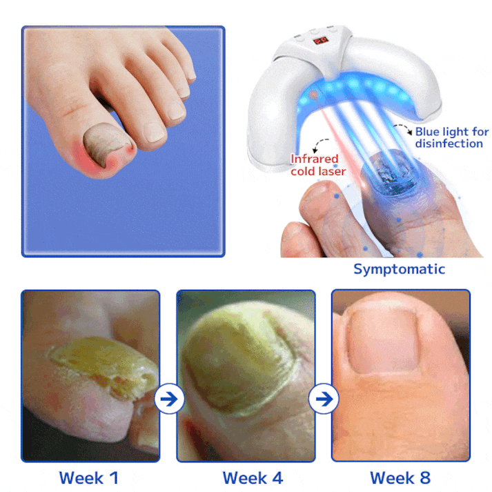 Furzero™ Fungal Nail Treatment Laser Device