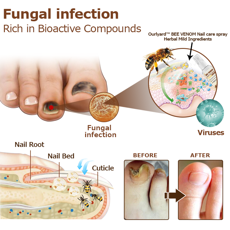 🐝Furzero™ Bee Venom Nail Psoriasis Treatment Spray