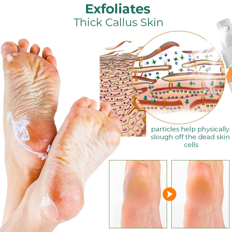 Furzero™ Foot Callus Removal Spray