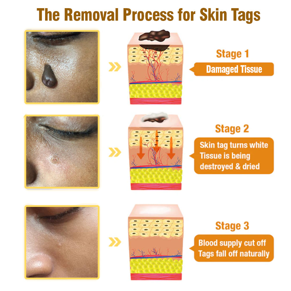 ✨flysmus™ Bee Venom Tags Removal Cream