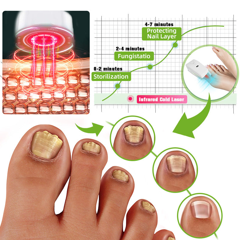 Furzero™ Nail Fungus Laser Therapy Device Max